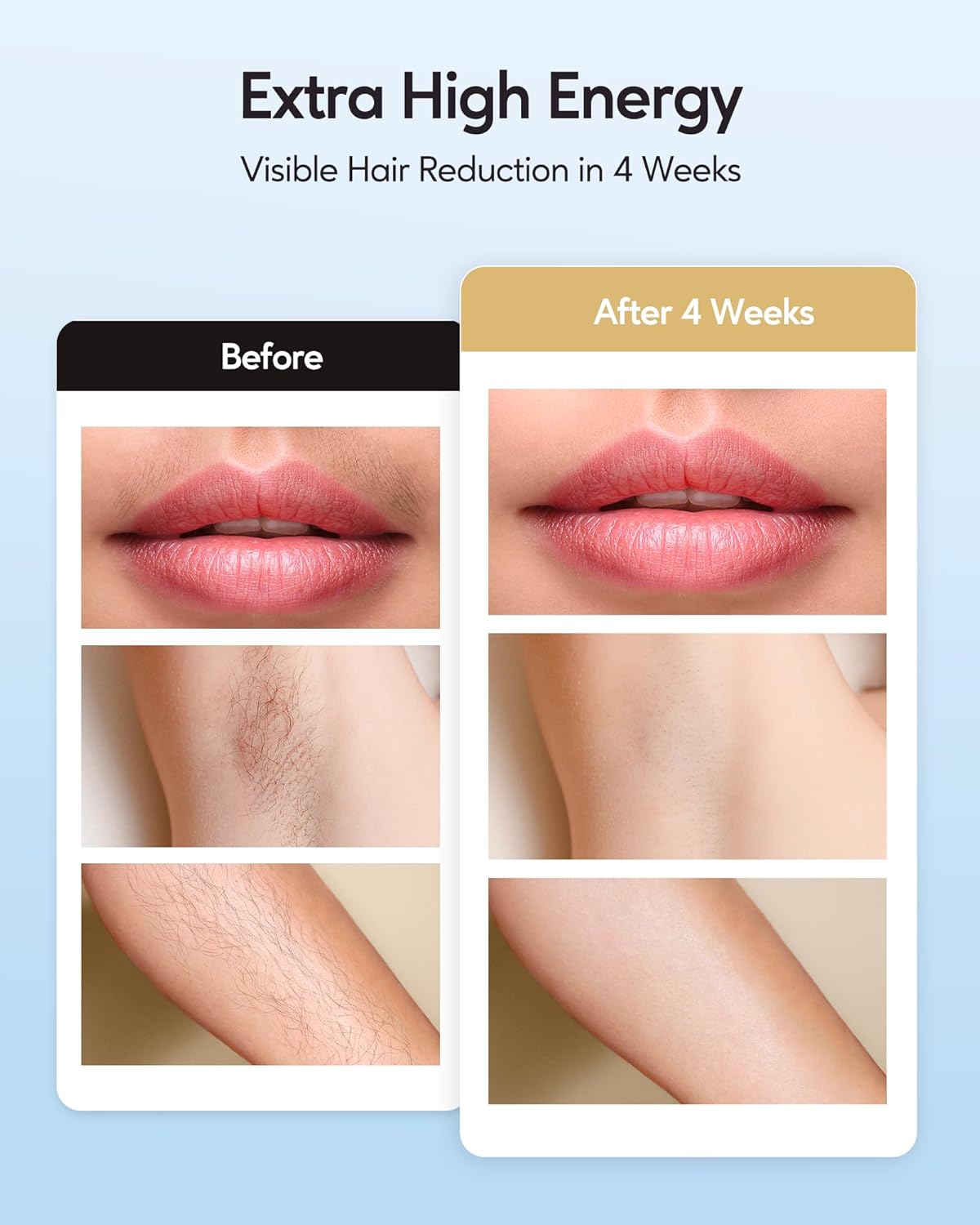 IPL Hair Removal with Ice Cooling Care Function for Women