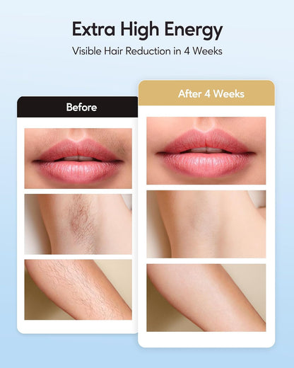 IPL Hair Removal with Ice Cooling Care Function for Women
