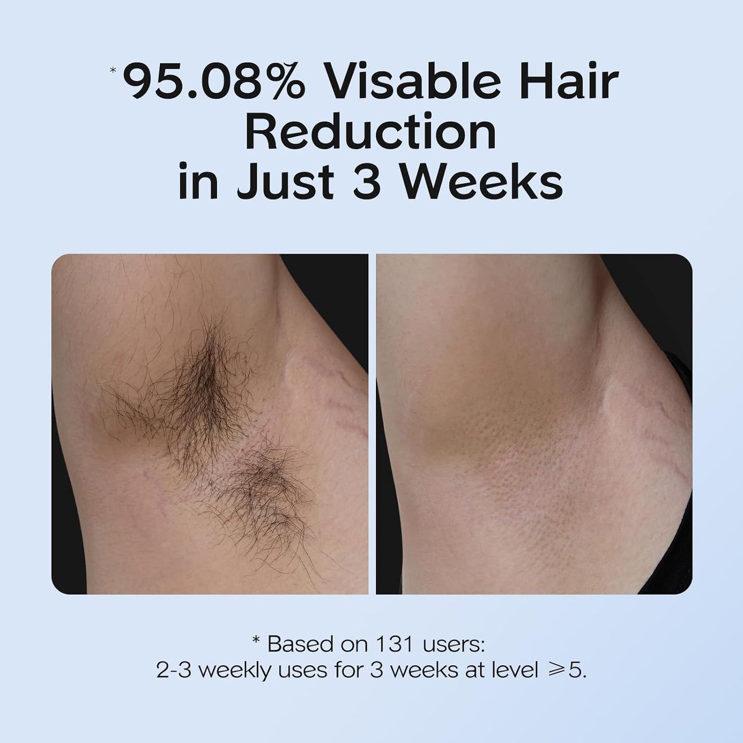 IPL Hair Removal Device for Armpits, Legs, Arms, Bikini Line & Corded